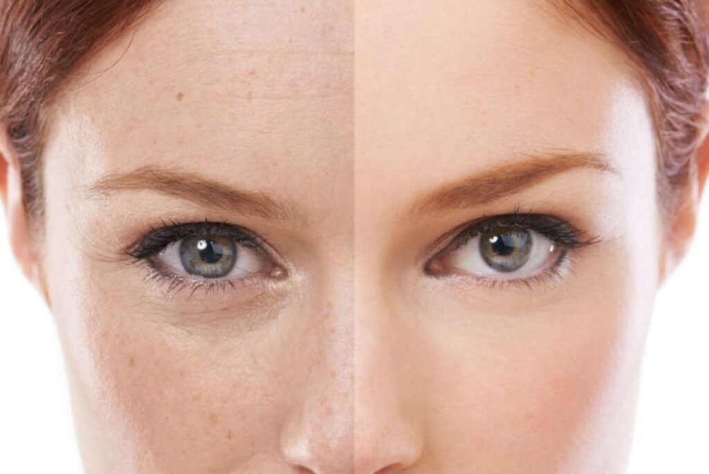 chemical peel london